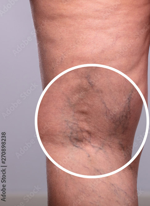 Photo of the patient’s leg before Varicose and Spider veins Treatment. Patient 1 - Set 1