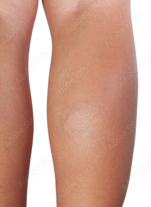 Photo of the patient’s leg after Varicose and Spider veins Treatment. Patient 3 - Set 1