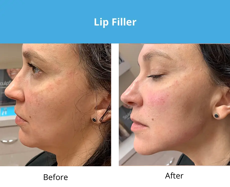 Photo of the patient’s face before and after Lip Filler. Patient 4 - Set 1