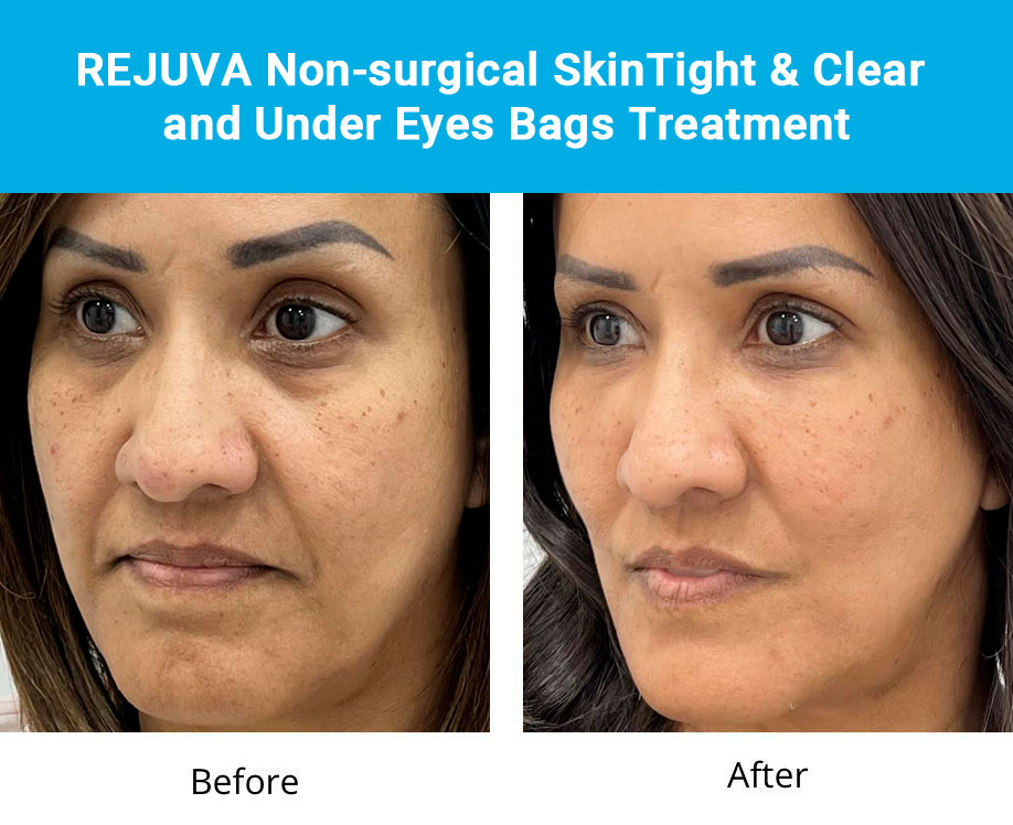 REJUVA Non-surgical SkinTight & Clear and Under Eyes Bags Treatment
