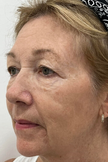 Photo of the patient’s face after Brown Spots Laser Treatment. Patient 1 - Set 1
