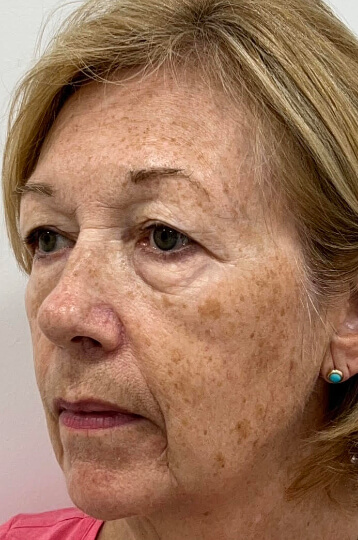 Photo of the patient’s face before Brown Spots Laser Treatment. Patient 1 - Set 1