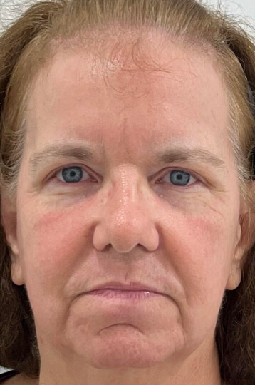 Photo of the patient’s face after Skin Brightening and Fine Lines Treatment. Patient 2 - Set 1