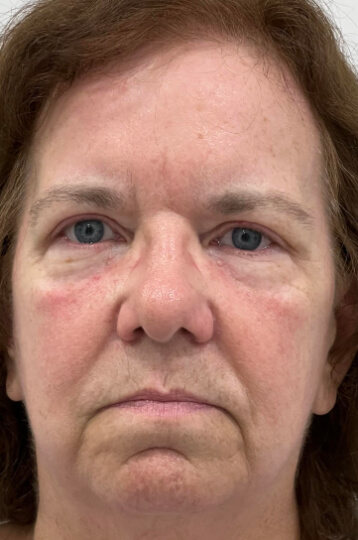 Photo of the patient’s face before Skin Brightening and Fine Lines Treatment. Patient 2 - Set 1