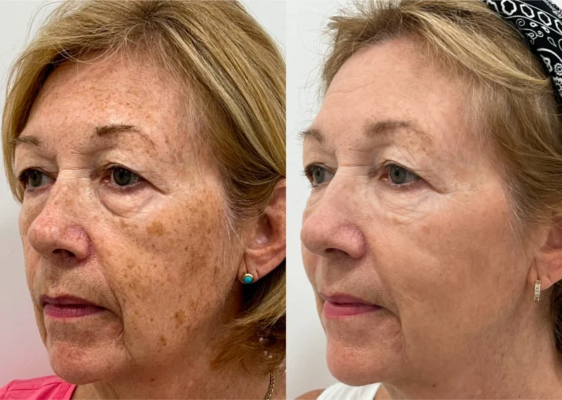 http://Female%20face,%20before%20and%20after%20Sun%20Spots%20&%20Age%20Spots%20Laser%20Treatment,%20set%201,%20patient%201 photo
