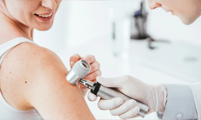 Skin Cancer photo