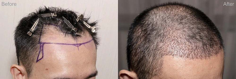 hair transplants 1