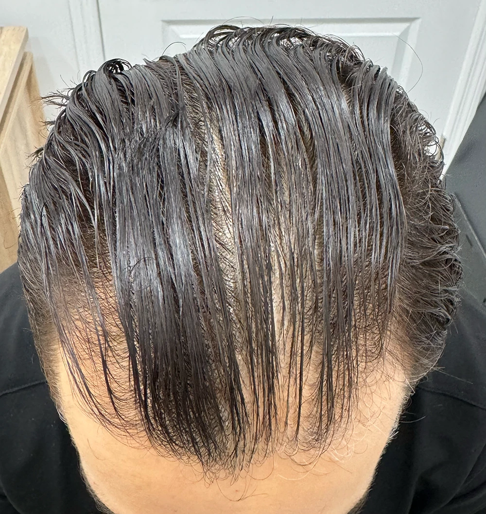 hair transplants 2