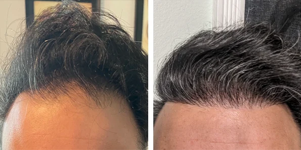 Photo of the patient’s face after REJUVA Non-Surgical Hair Transplant. Patient 1