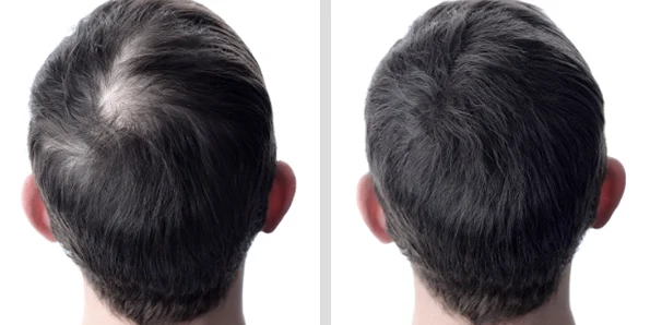 Photo of the patient’s face after REJUVA Non-Surgical Hair Transplant. Patient 10