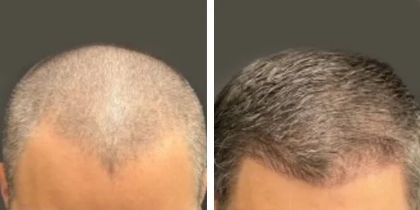 Photo of the patient’s face after REJUVA Non-Surgical Hair Transplant. Patient 11