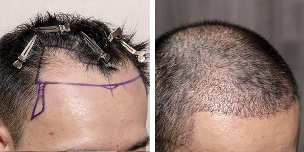 Photo of the patient’s face after REJUVA Non-Surgical Hair Transplant. Patient 2