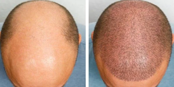 Photo of the patient’s face after REJUVA Non-Surgical Hair Transplant. Patient 3