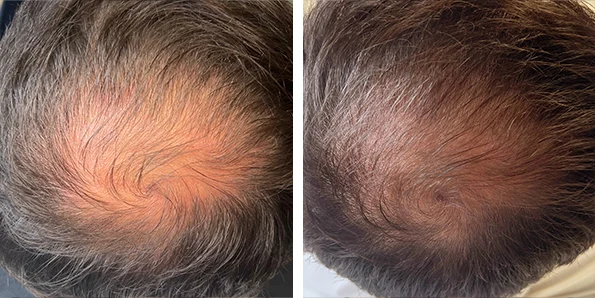 Photo of the patient’s face after REJUVA Non-Surgical Hair Transplant. Patient 5
