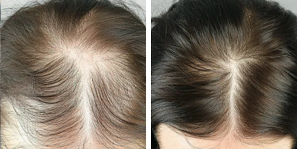 Photo of the patient’s face after REJUVA Non-Surgical Hair Transplant. Patient 6