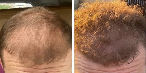 Photo of the patient’s face after REJUVA Non-Surgical Hair Transplant. Patient 7