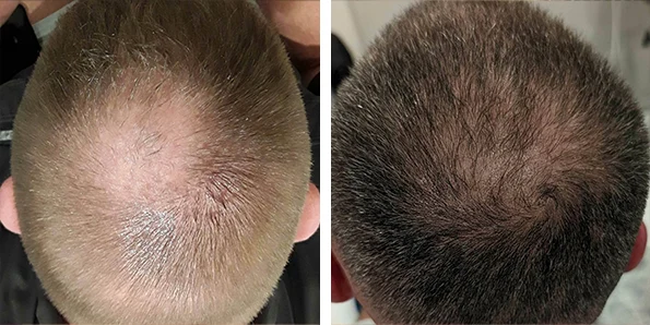 Photo of the patient’s face after REJUVA Non-Surgical Hair Transplant. Patient 8