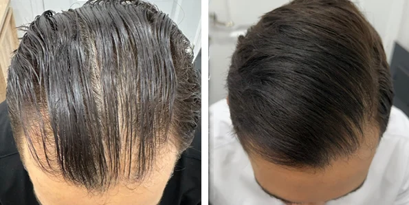 Photo of the patient’s face after REJUVA Non-Surgical Hair Transplant. Patient 9