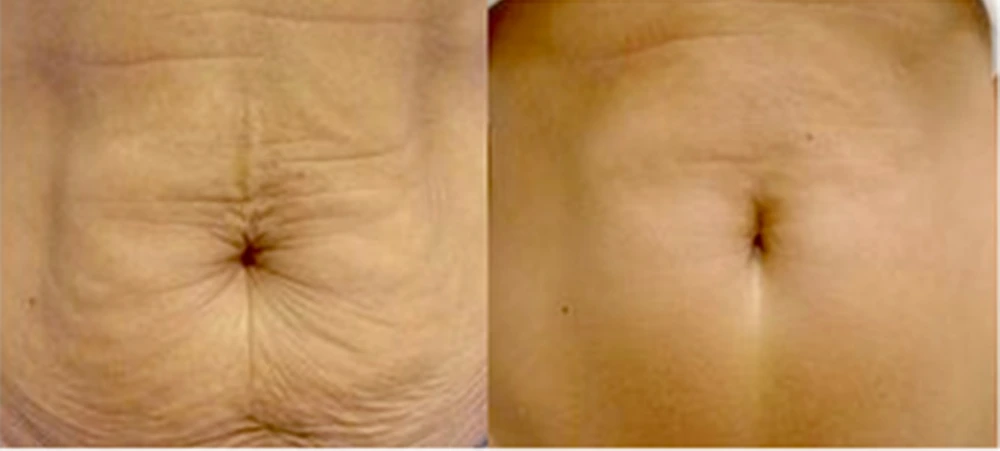 Photo of the patient’s face after REJUVA Non-Surgical Hair Transplant. Patient 3