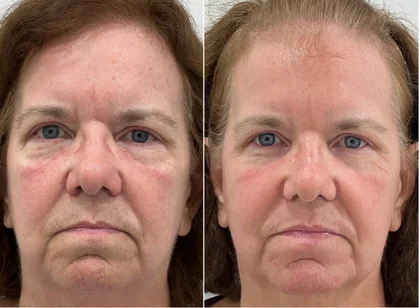 Female face, before and after CO2 Resurfacing Laser Treatment, front view (patient 2)