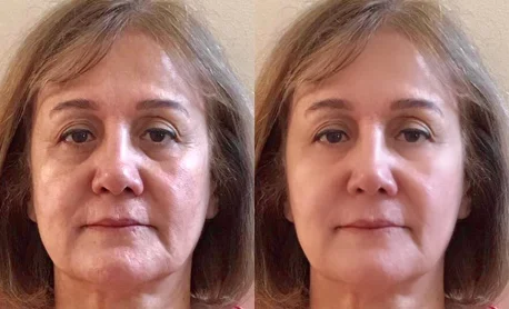 Female face, before and after Radiofrequency (RF) Microneedling treatment, front view (patient 1)