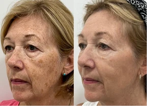 Female face, before and after Intense Pulsed Light (IPL) Therapy treatment, oblique view (patient 1)
