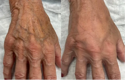 Female hands, before and after Intense Pulsed Light (IPL) Therapy treatment, front view (patient 2)