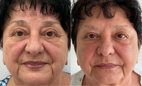 Female face, before and after Radiofrequency (RF) Microneedling treatment, front view (patient 2)