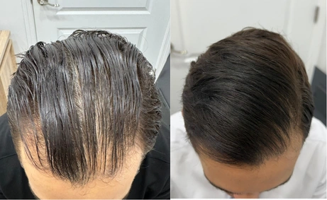 http://Male%20head,%20before%20and%20after%20Hair%20Loss%20Treatment,%20set%201,%20patient%203 photo