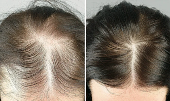 Hair Loss Treatments photo