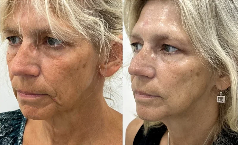 http://Female%20face,%20before%20and%20after%20Non%20Surgical%20Face%20and%20Neck%20Lift%20treatment,%20set%201,%20patient%202 photo
