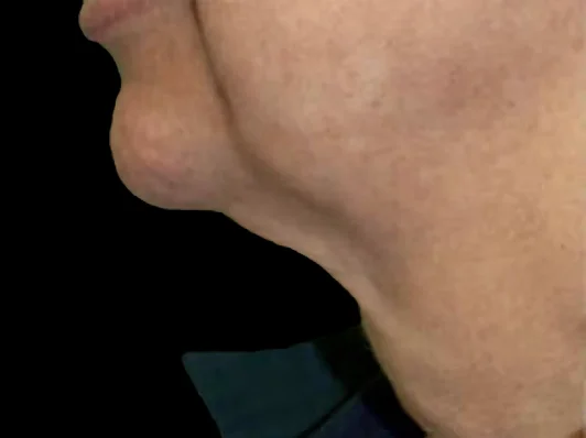 lift-before
