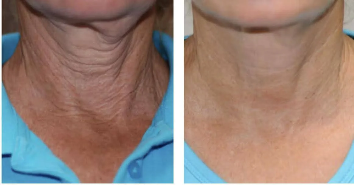 neck-before-after