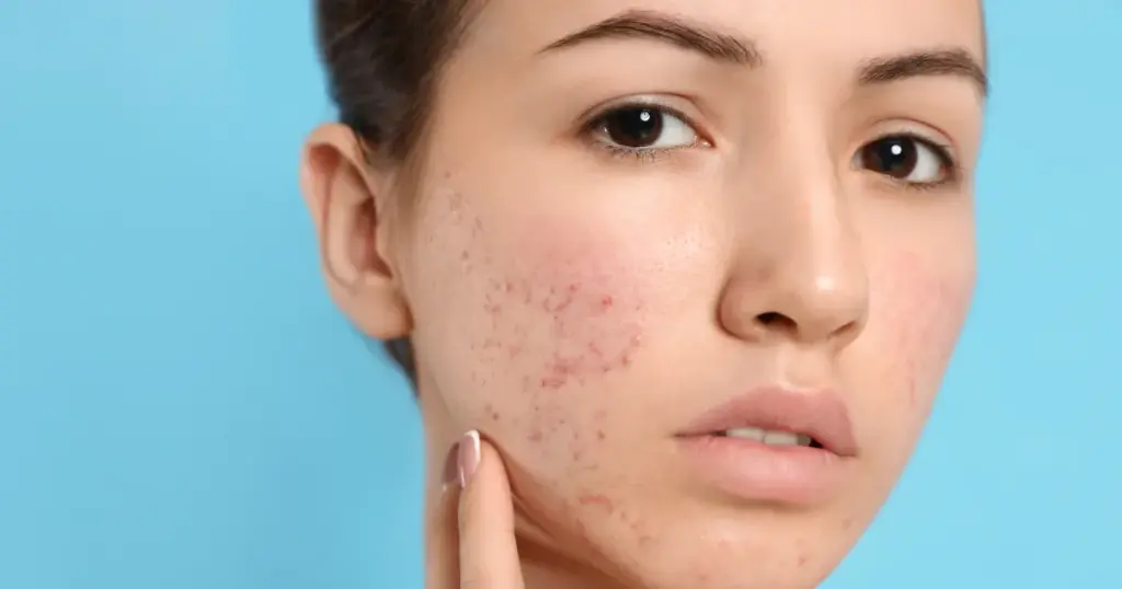 A woman looking for Acne Treatment in Venice, FL to achieve clear, healthy skin