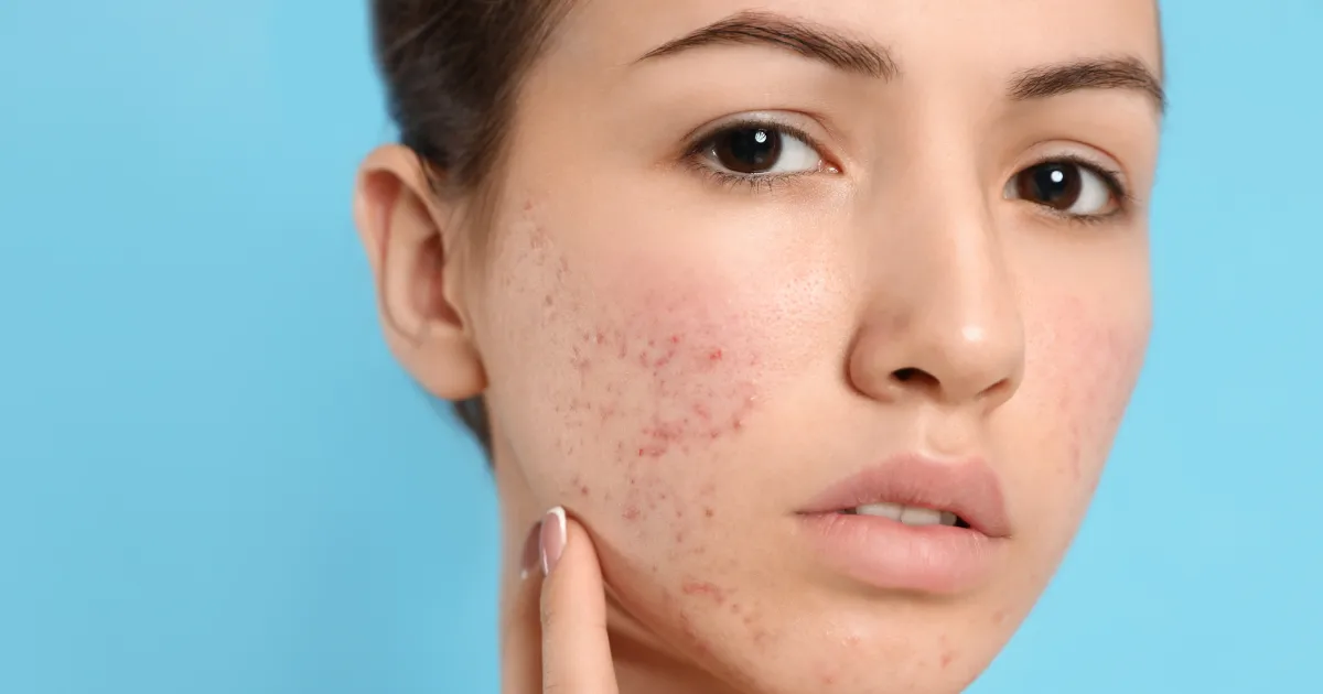A woman looking for Acne Treatment in Venice, FL to achieve clear, healthy skin
