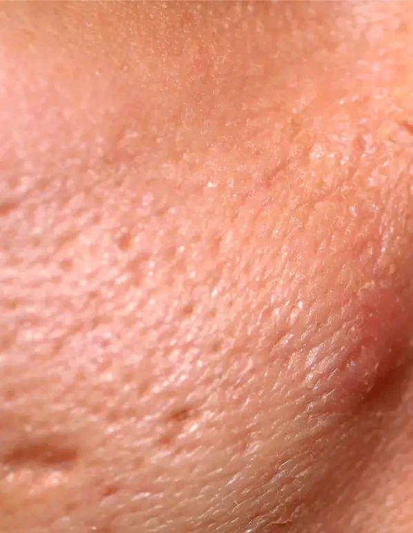 Acne Scars Treatment in Venice, FL at Rejuva Dermatology & Vein Center