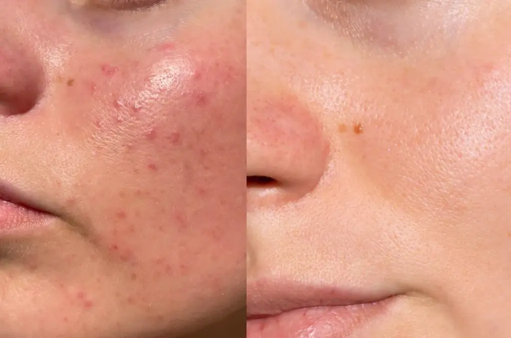 Acne Treatment in Venice, FL at Rejuva Dermatology & Vein Center