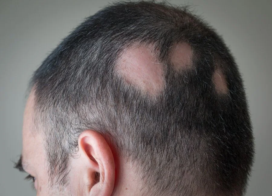 Alopecia Areata Treatment in Venice, FL | Rejuva Dermatology