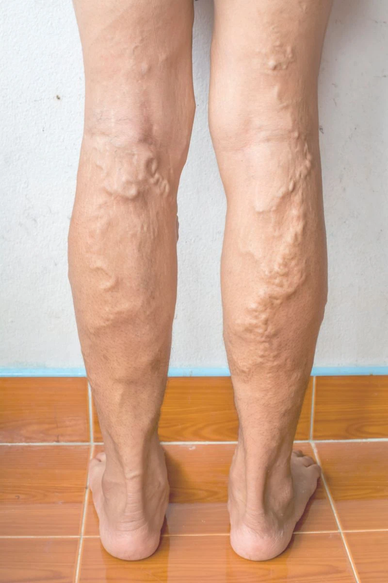 Chronic Venous Insufficiency (CVI)