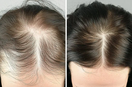 Hair growth cycle phases diagram showing anagen to telogen