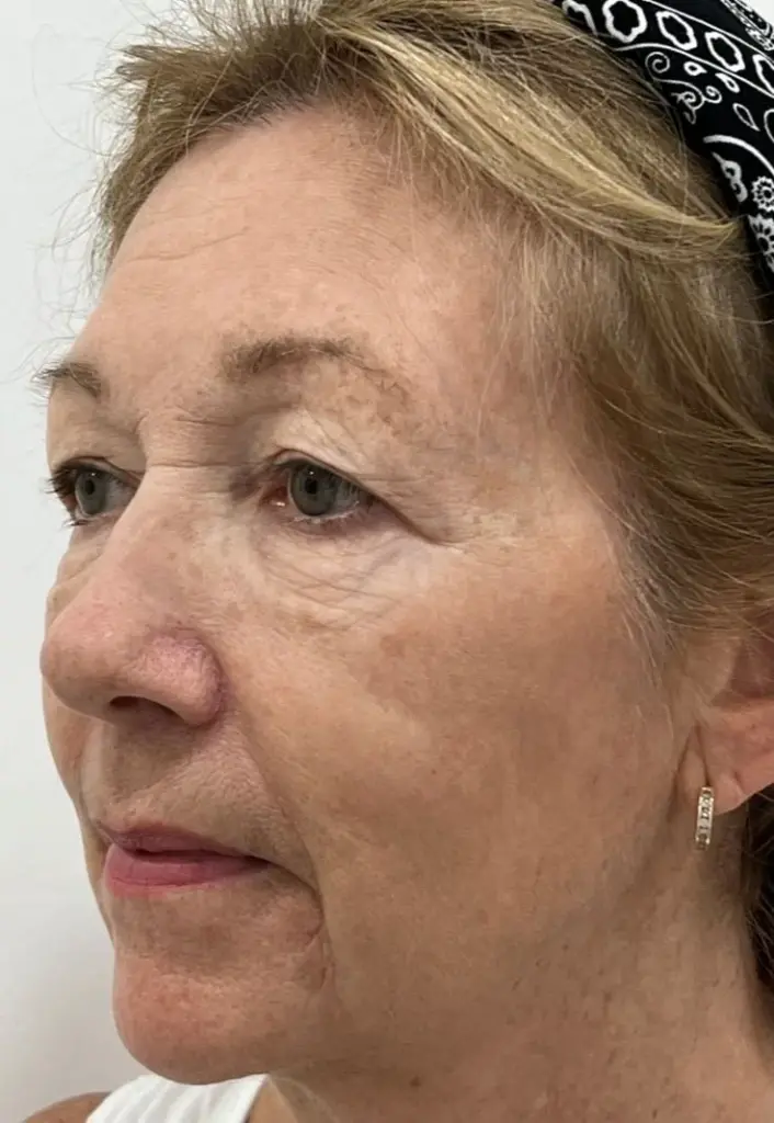 After IPL photofacial showing clearer skin with fewer spots