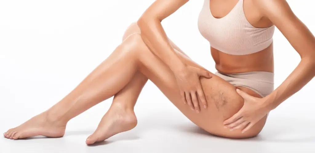 RF Vein Treatment in Venice, FL at Rejuva Dermatology & Vein Center