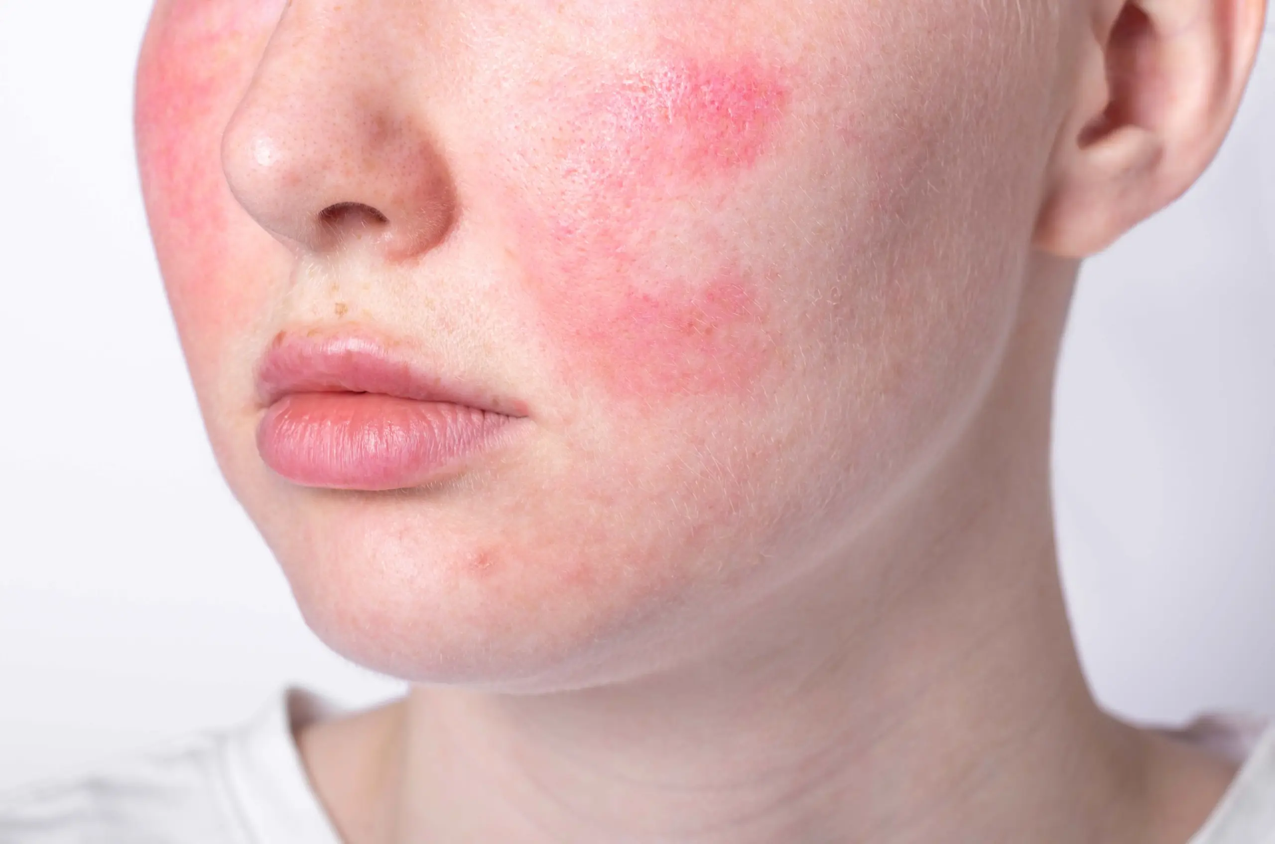 Facial rosacea laser treatment | REJUVA Dermatology