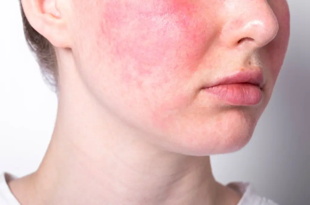 Rosacea in Venica