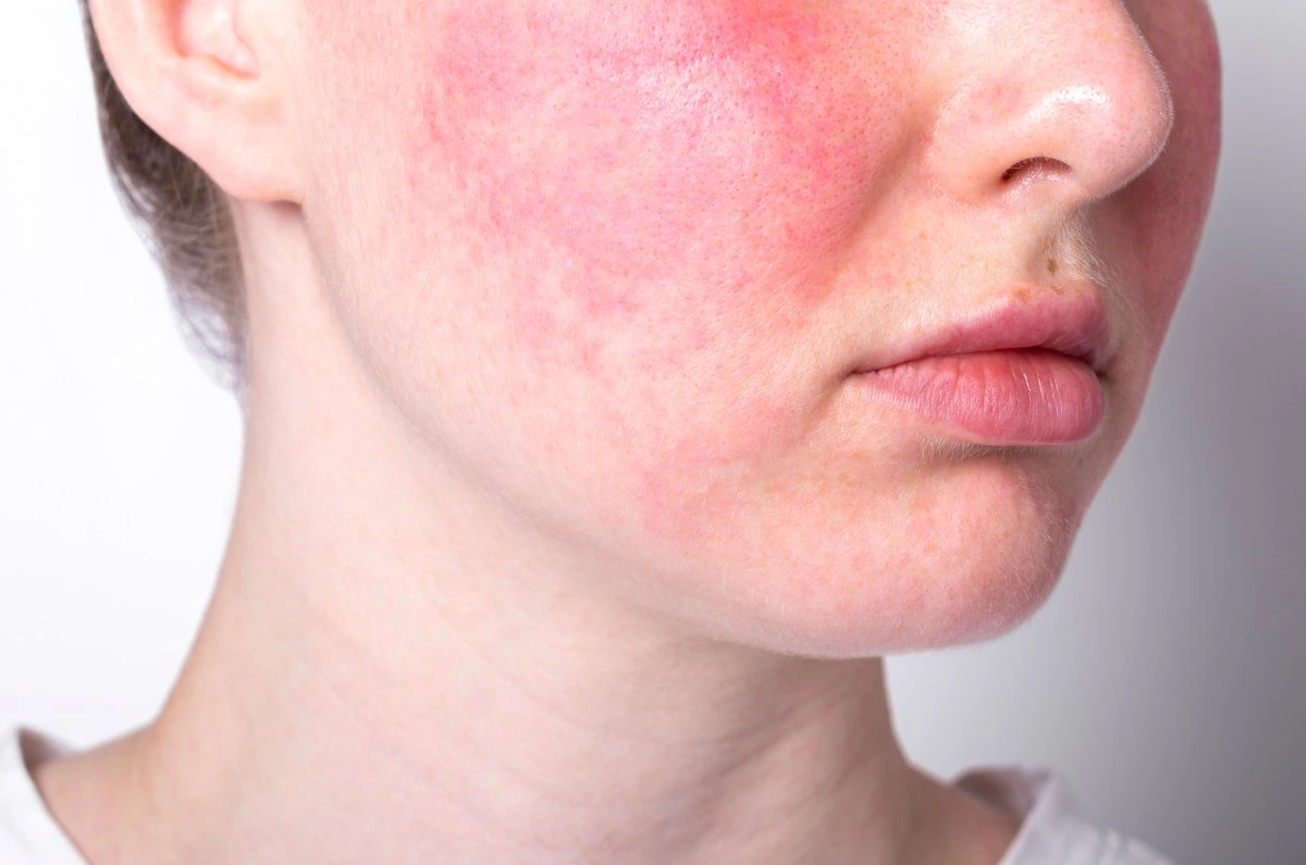 Rosacea in Venica