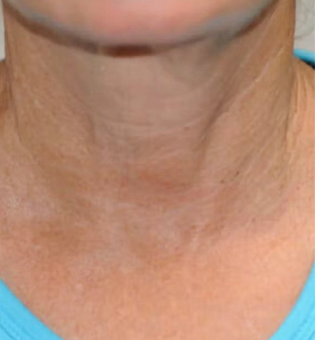 REJUVA UltraRF Skin Tightening and Fat Loss