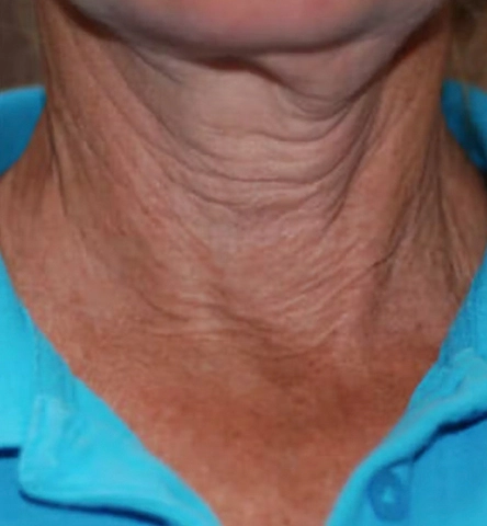 REJUVA UltraRF Skin Tightening and Fat Loss