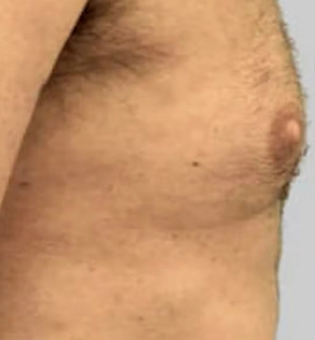 REJUVA UltraRF Skin Tightening and Fat Loss