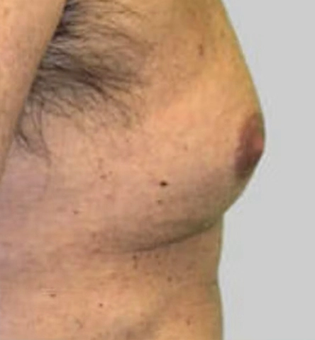 REJUVA UltraRF Skin Tightening and Fat Loss