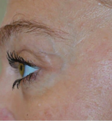 REJUVA UltraRF Skin Tightening and Fat Loss